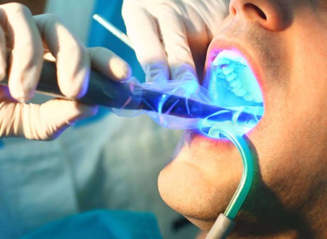 L'ozono in odontoiatria